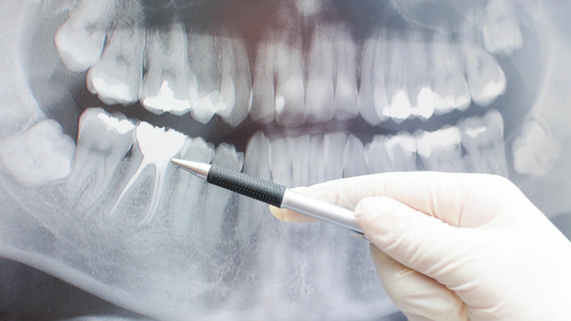 Root Canals